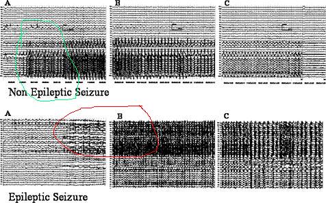 Note differences in onset